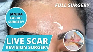 SCAR REVISION SURGERY ON FOREHEAD - DR. TANVEER JANJUA - NEW JERSEY