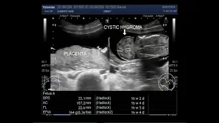 Ultrasound Video showing Cystic hygroma with Microcephaly.