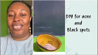 DIY for acne and dark spots #diy #skincare #adaatigogo