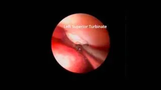 endoscopic sphenoidotomy English Version