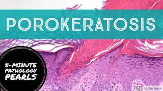 Porokeratosis: 5-Minute Pathology Pearls