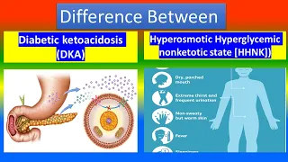 Diabetic ketoacidosis (DKA) Vs. Hyperosmotic Hyperglycemic nonketotic state ( HHNK )