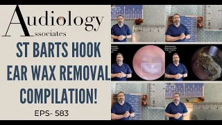 ST BARTS HOOK EAR WAX REMOVAL COMPILATION - EP583