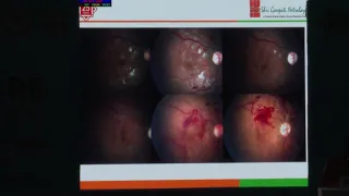 AIOC2019 Hyde Park IV FP1624   Unusual Presentation of Post  Pyrexial   Dr  Amit Jain