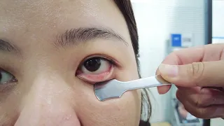 How to flip eyelids inside out (Dry eye treatment - Meibomian glands)