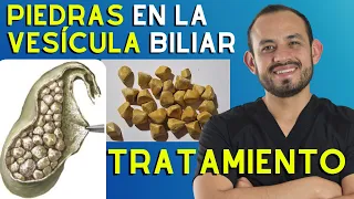 🥑 Síntomas y TRATAMIENTO de las Piedras en la Vesícula (Colelitiasis y Colecistitis)