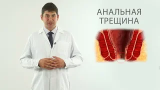 анальная трещина диагностика, лечение