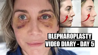 Blepharoplasty Video Diary - Day 5 After Surgery (4 of 15)