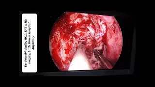 Endoscopic optic nerve decompression for traumatic optic neuropathy (acute blindness)