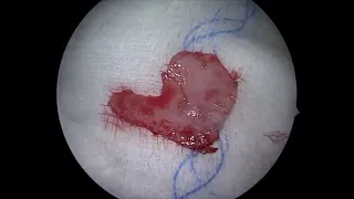 Steps of Septoplasty - Full Surgical Video