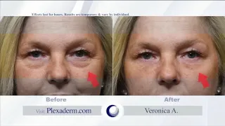 Plexaderm For Your Fine Lines and Wrinkles