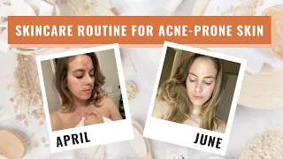 My Morning and Night Skincare Routine for Acne-Prone Skin | Lucie Fink