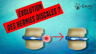 HERNIE DISCALE : ÉVOLUTION NATURELLE SANS TRAITEMENT