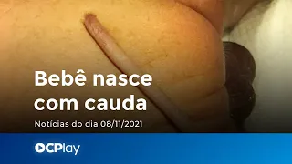 Bebê nasce com cauda