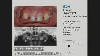 E16.2 GenoDENT: A targeted next-generation sequencing assay for the molecular diagnosis