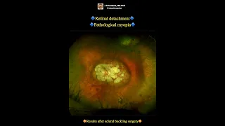 Retinal detachment. Pathological myopia. Scleral buckling surgery.