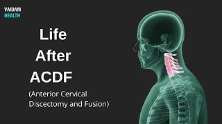 Life After ACDF (Anterior Cervical Discectomy and Fusion)