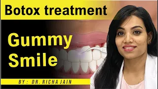 Botox Treatment for Gummy Smile by Dr. Richa Jain | Skinaa Clinic