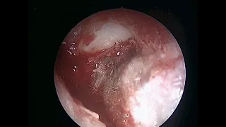 Canalplasty, neotympanum, canal atresia,congenital ear canal stenosis, Pankaj E.N.T Hospital