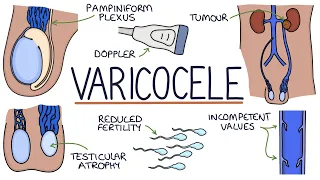 Varicoceles
