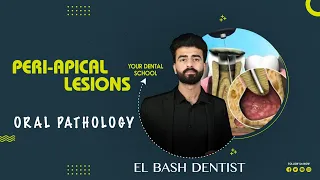 periapical lesions | granuloma and abscess | oral pathology _ عزت شومان