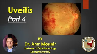 Uveitis Part 4