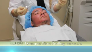 Dermapen Micro Needling - La Jolla Cosmetic Laser Clinic
