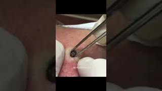 The Most Popular Blackhead Pop of ALL TIME! #shorts