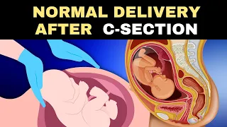 Normal Delivery after Cesarean Delivery | Vaginal Birth after Cesarean (VBAC): Risks and Benefits