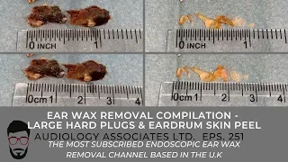 EAR WAX REMOVAL COMPILATION - LARGE HARD PLUGS & EARDRUM SKIN PEEL - EP 251