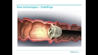 FUSE, E-WAVE, Endorings, etc. - Evidence based benefit for colonoscopy?