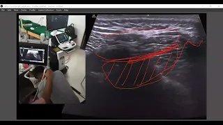 Anatomy and sonoanatomy of Occipital Nerve | Occipital Nerve Block