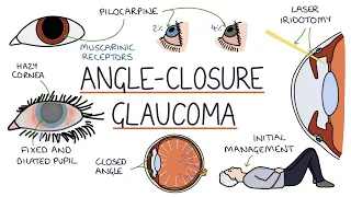 Understanding Acute Angle Closure Glaucoma