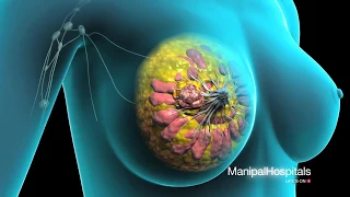 Surgical Procedure For Breast Removal | Lumpectomy Surgery | Mastectomy - Manipal Hospital