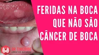 Feridas ou lesões na boca que NÃO são câncer de boca | Dr Jônatas Catunda