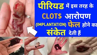 पीरियड में इस तरह के Clots आरोपण फेल होने का संकेत देती है|क्या करे कि गर्भ खराब ना हो|IMPLANTATION|