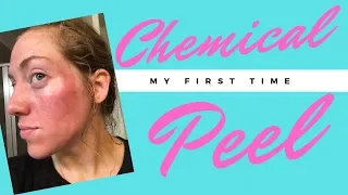 Getting a Chemical Peel || Before and After Results || Why I Cried