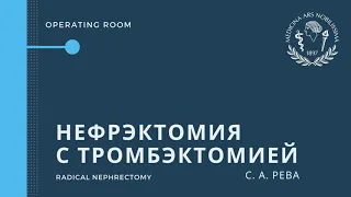 Лапароскопическая нефрэктомия с тромбэктомией