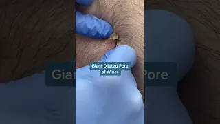 How to Remove a Dilated pore of winer #pimplepopping #shorts