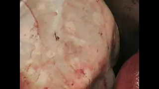 Acute cholecystitis Liver abscess Гострий холецистит Абсцес печінки