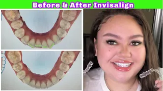 AMAZING BEFORE AND AFTER INVISALIGN!