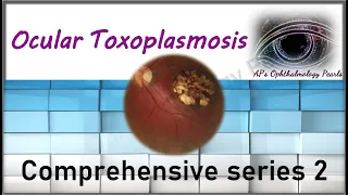 Ocular toxoplasmosis | Comprehensive series 2