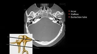 5 Petrous bone Imaging ( part I) -  Prof.Mamdouh mahfouz (2019 edition)