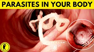 9 Early Symptoms of Parasites In Your Body (DON’T IGNORE)