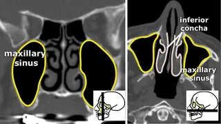 Компьютерная томография околоносовых пазух: почему важно знать анатомию, как не пропустить патологию