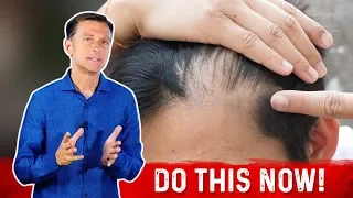 Receding Hairline: Causes And Remedies – Dr.Berg