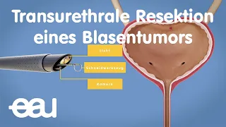 TURBT - Transurethrale Resektion eines Blasentumors