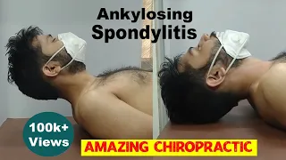 Amazing Recovery *Ankylosing Spondylitis* Chiropractic Treatment! Dr. Sanjay Sarkar