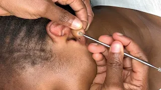 ASMR | real person ear cleaning & picking | well zoomed