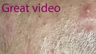 Acne Treatment Huong Da Nang# membership 016   Treatment for Dung | great video